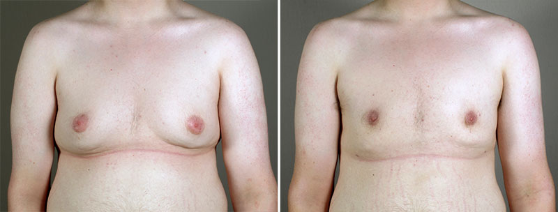 Gynecomastia Reduction Patient 41
