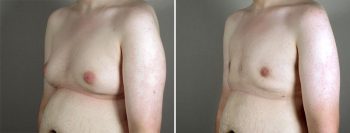 Gynecomastia Reduction Patient 41