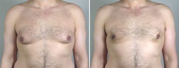 Gynecomastia Reduction Patient 43