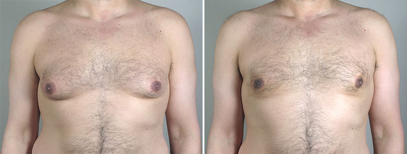 Gynecomastia Reduction Patient 43