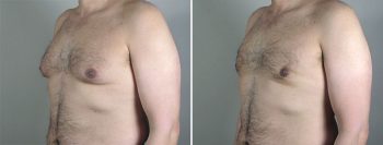 Gynecomastia Reduction Patient 43