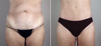 Parker Tummy Tuck Patient 46