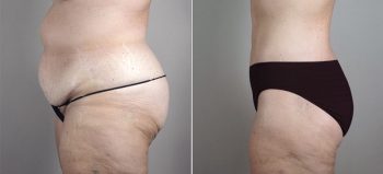 Parker Tummy Tuck Patient 46