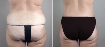 Parker Tummy Tuck Patient 46