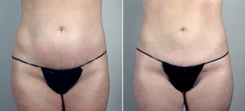 Breast Enlargement (Augmentation) Patient 82