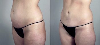 Breast Enlargement (Augmentation) Patient 82