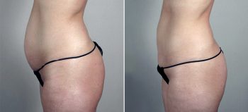 Breast Enlargement (Augmentation) Patient 82