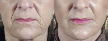 Face Lift Patient 29