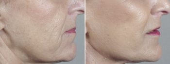 Face Lift Patient 29