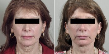 Face Lift Patient 30