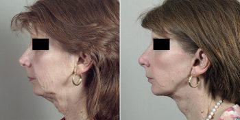 Face Lift Patient 30