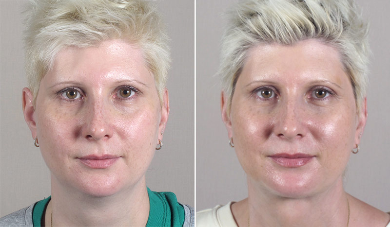 Neck Liposuction Patient 13