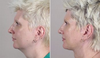 Neck Liposuction Patient 13