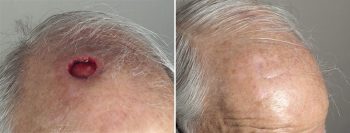 Skin Cancer Treatment Patient 43