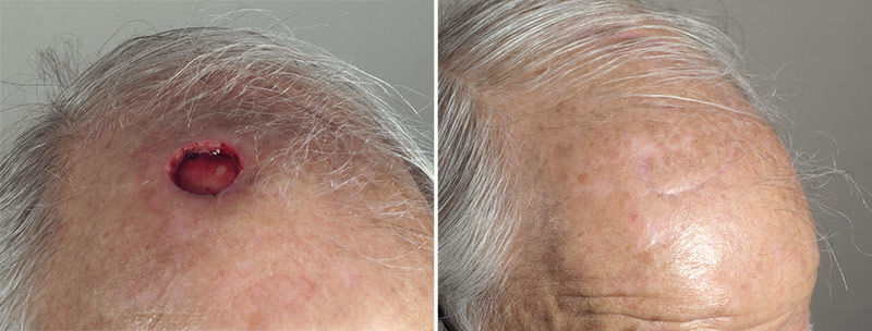 Skin Cancer Treatment Patient 43