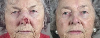 Skin Cancer Treatment Patient 45