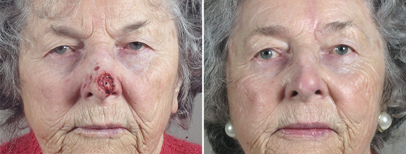 Skin Cancer Treatment Patient 45