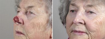 Skin Cancer Treatment Patient 45