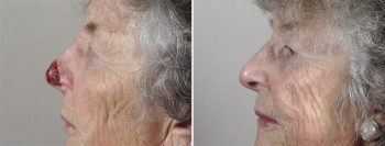 Skin Cancer Treatment Patient 45