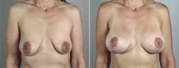 Breast Lift with Implants Patient 36