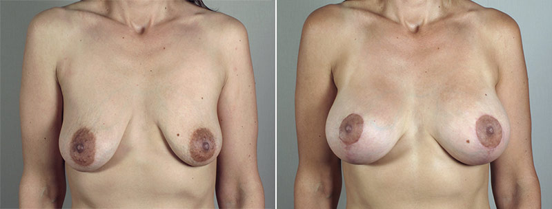 Breast Lift with Implants Patient 36