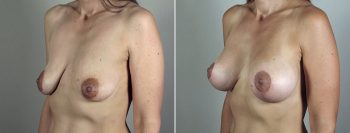 Breast Lift with Implants Patient 36
