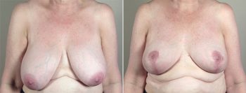 Breast Lift (Vertical Mastopexy) with Reduction Patient 16