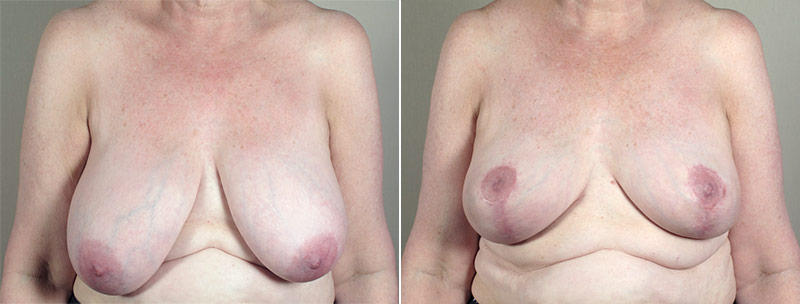 Breast Lift (Vertical Mastopexy) with Reduction Patient 16
