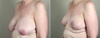 Breast Lift (Vertical Mastopexy) with Reduction Patient 16