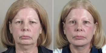 Face Lift Patient 31