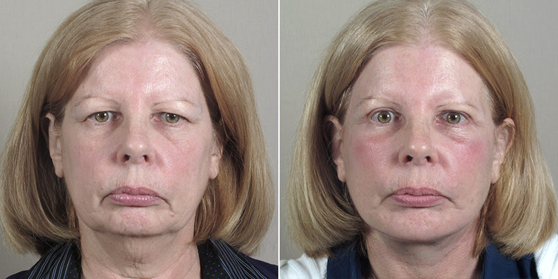 Face Lift Patient 31
