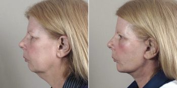 Face Lift Patient 31