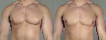 Gynecomastia Reduction Patient 44