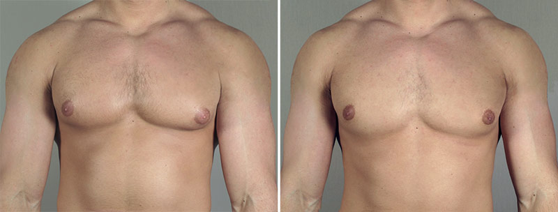 Gynecomastia Reduction Patient 44