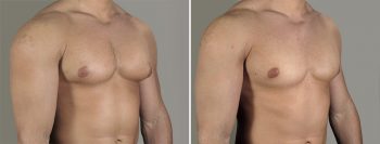 Gynecomastia Reduction Patient 44