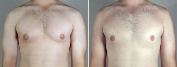 Gynecomastia Reduction Patient 45