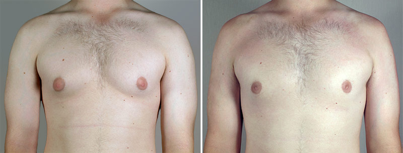 Gynecomastia Reduction Patient 45