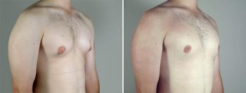 Gynecomastia Reduction Patient 45