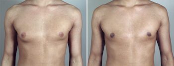 Gynecomastia Reduction Patient 46