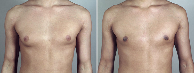 Gynecomastia Reduction Patient 46
