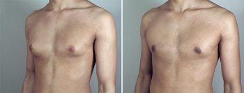 Gynecomastia Reduction Patient 46