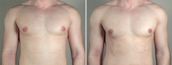 Gynecomastia Reduction Patient 47