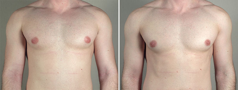 Gynecomastia Reduction Patient 47