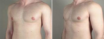 Gynecomastia Reduction Patient 47