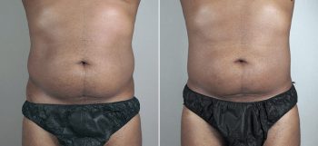 Male Liposuction Patient 24
