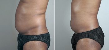 Male Liposuction Patient 24
