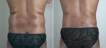 Male Liposuction Patient 24