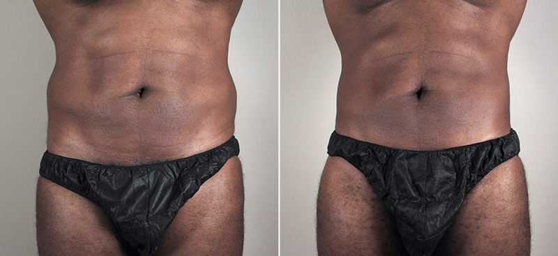 Male Liposuction Patient 25