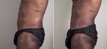 Male Liposuction Patient 25