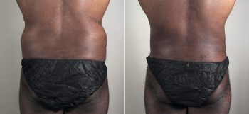 Male Liposuction Patient 25